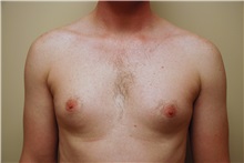 Male Breast Reduction Before Photo by Jon Harrell, DO, FACS; Weston, FL - Case 24320