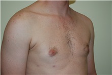 Male Breast Reduction After Photo by Jon Harrell, DO, FACS; Weston, FL - Case 24320