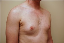 Male Breast Reduction Before Photo by Jon Harrell, DO, FACS; Weston, FL - Case 24320