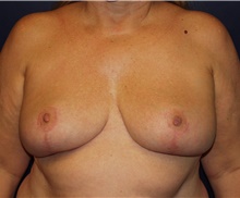 Breast Reduction After Photo by Barry Douglas, MD, FACS; Garden City, NY - Case 43283