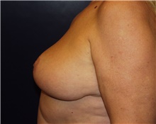 Breast Reduction After Photo by Barry Douglas, MD, FACS; Garden City, NY - Case 43283
