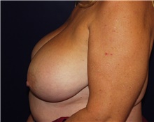 Breast Reduction Before Photo by Barry Douglas, MD, FACS; Garden City, NY - Case 43283