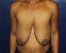 Breast Reduction Before Photo by Barry Douglas, MD, FACS; Garden City, NY - Case 43284