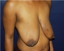 Breast Reduction Before Photo by Barry Douglas, MD, FACS; Garden City, NY - Case 43284