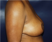 Breast Reduction After Photo by Barry Douglas, MD, FACS; Garden City, NY - Case 43284