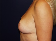 Breast Reduction After Photo by Barry Douglas, MD, FACS; Garden City, NY - Case 43286