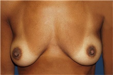 Breast Augmentation Before Photo by Barry Douglas, MD, FACS; Garden City, NY - Case 43287