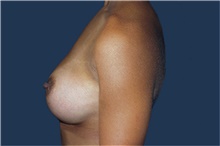 Breast Augmentation After Photo by Barry Douglas, MD, FACS; Garden City, NY - Case 43287