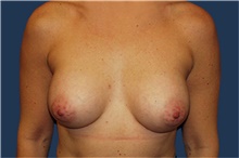 Breast Augmentation After Photo by Barry Douglas, MD, FACS; Garden City, NY - Case 43288