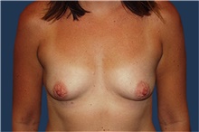 Breast Augmentation Before Photo by Barry Douglas, MD, FACS; Garden City, NY - Case 43288
