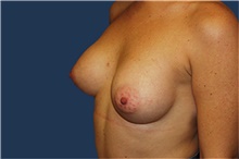 Breast Augmentation After Photo by Barry Douglas, MD, FACS; Garden City, NY - Case 43288