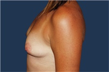 Breast Augmentation Before Photo by Barry Douglas, MD, FACS; Garden City, NY - Case 43288