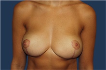Breast Reduction After Photo by Barry Douglas, MD, FACS; Garden City, NY - Case 43292