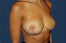 Breast Reduction After Photo by Barry Douglas, MD, FACS; Garden City, NY - Case 43292