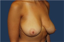 Breast Reduction Before Photo by Barry Douglas, MD, FACS; Garden City, NY - Case 43292