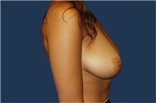 Breast Reduction Before Photo by Barry Douglas, MD, FACS; Garden City, NY - Case 43292