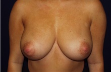Breast Reduction Before Photo by Barry Douglas, MD, FACS; Garden City, NY - Case 43295
