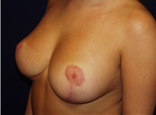 Breast Reduction After Photo by Barry Douglas, MD, FACS; Garden City, NY - Case 43295