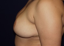 Breast Reduction After Photo by Barry Douglas, MD, FACS; Garden City, NY - Case 43296