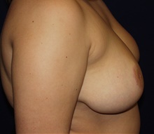 Breast Reduction After Photo by Barry Douglas, MD, FACS; Garden City, NY - Case 43296