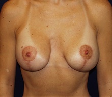 Breast Augmentation After Photo by Barry Douglas, MD, FACS; Garden City, NY - Case 43303