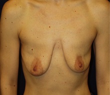 Breast Augmentation Before Photo by Barry Douglas, MD, FACS; Garden City, NY - Case 43303