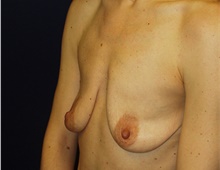 Breast Augmentation Before Photo by Barry Douglas, MD, FACS; Garden City, NY - Case 43303