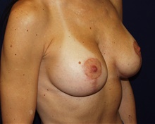 Breast Augmentation After Photo by Barry Douglas, MD, FACS; Garden City, NY - Case 43303
