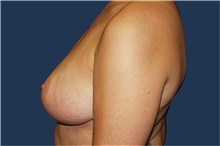 Breast Reduction After Photo by Barry Douglas, MD, FACS; Garden City, NY - Case 44867