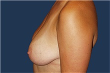 Breast Reduction Before Photo by Barry Douglas, MD, FACS; Garden City, NY - Case 44867