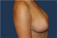 Breast Reduction After Photo by Barry Douglas, MD, FACS; Garden City, NY - Case 44867