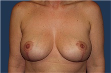 Breast Augmentation After Photo by Barry Douglas, MD, FACS; Garden City, NY - Case 44868