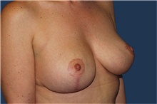 Breast Augmentation After Photo by Barry Douglas, MD, FACS; Garden City, NY - Case 44868