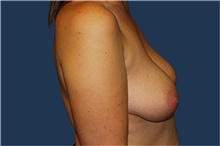 Breast Augmentation Before Photo by Barry Douglas, MD, FACS; Garden City, NY - Case 44868