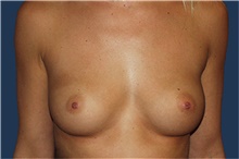 Breast Augmentation Before Photo by Barry Douglas, MD, FACS; Garden City, NY - Case 44869