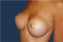 Breast Augmentation After Photo by Barry Douglas, MD, FACS; Garden City, NY - Case 44869