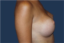 Breast Augmentation After Photo by Barry Douglas, MD, FACS; Garden City, NY - Case 44869