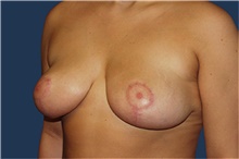 Breast Lift After Photo by Barry Douglas, MD, FACS; Garden City, NY - Case 44870