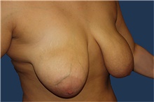 Breast Lift Before Photo by Barry Douglas, MD, FACS; Garden City, NY - Case 44870