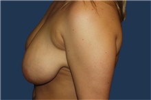 Breast Lift Before Photo by Barry Douglas, MD, FACS; Garden City, NY - Case 44870
