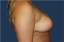 Breast Lift After Photo by Barry Douglas, MD, FACS; Garden City, NY - Case 44870