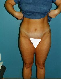 Liposuction After Photo by Walter Sorokolit, MD; Fort Worth, TX - Case 6824