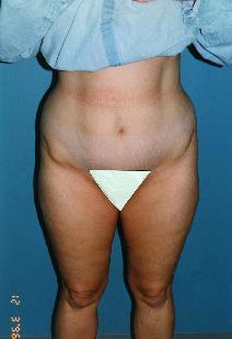 Liposuction Before Photo by Walter Sorokolit, MD; Fort Worth, TX - Case 6824