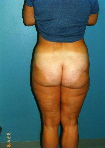 Liposuction After Photo by Walter Sorokolit, MD; Fort Worth, TX - Case 6824