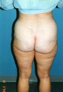 Liposuction Before Photo by Walter Sorokolit, MD; Fort Worth, TX - Case 6824