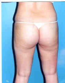 Liposuction After Photo by Walter Sorokolit, MD; Fort Worth, TX - Case 6825