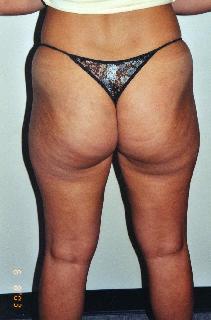 Liposuction Before Photo by Walter Sorokolit, MD; Fort Worth, TX - Case 6825