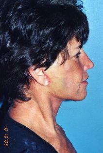 Facelift After Photo by Walter Sorokolit, MD; Fort Worth, TX - Case 6844