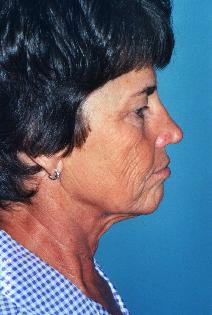 Facelift Before Photo by Walter Sorokolit, MD; Fort Worth, TX - Case 6844