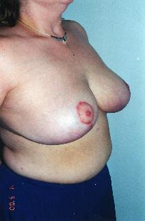Breast Reduction After Photo by Walter Sorokolit, MD; Fort Worth, TX - Case 6847